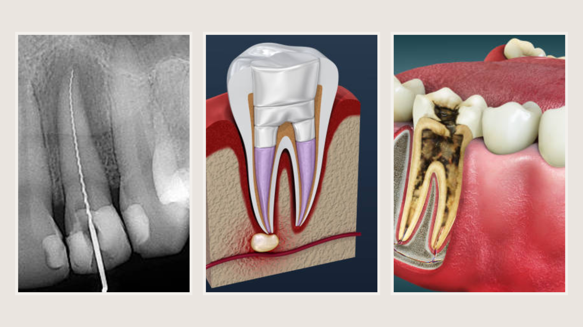 How Rct Is Done What Is RCT, and Is It Painful?